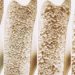 Osteoporose ist weltweit die häufigste Knochenerkrankung. Hierzulande sind über sechs Millionen Menschen betroffen. Und es werden mehr. Doch es gibt Möglichkeiten, der Krankheit vorzubeugen. (Bild: crevis/fotolia.com)