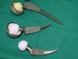 Hüftgelenksarthrose