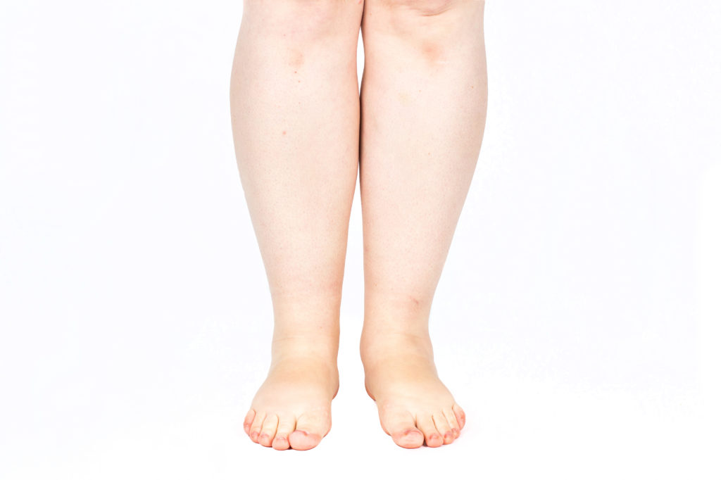 legs obese. Weight problems. trouble walking. paskosotopie, valgus knee