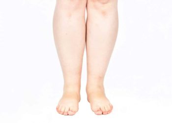 Viele Frauen haben mit verstärkten Fetteinlagerungen im Bereich von Oberschenkel und Hüfte zu kämpfen, was nicht zwangsweise im Zusammenhang mit Übergewicht stehen muss. (Bild: BarbaraKrupa/fotolia.com)