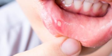 Ein trockener Mund führt schnell zu Entzündungen der Mundschleimhaut mit kleinen, schmerzhaften Bläschen. (Bild: sarmoho/stock.adobe.com)
