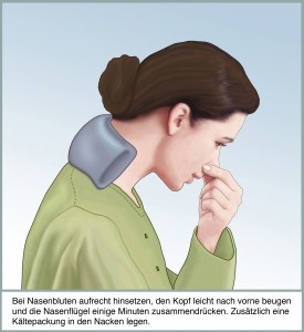 Bei Nasenbluten aufrecht hinsetzen, den Kopf leicht nach vorne beugen und die Nasenfluegel einige Minuten zusammendruecken. Zusaetzlich eine Kaeltepackung in den Nacken legen.