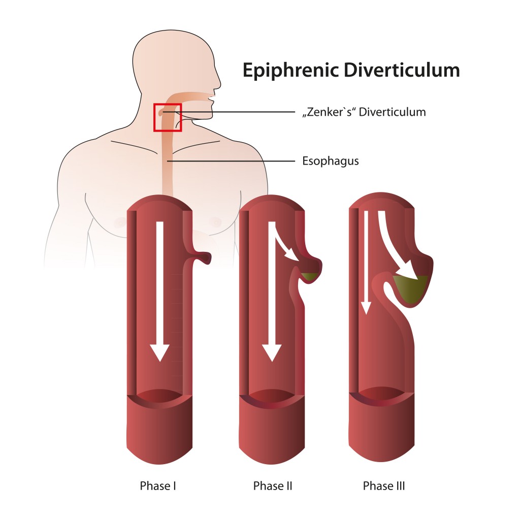 Diverticulum epiphrenic eps vector illustration