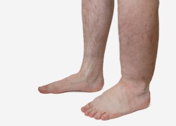 Manche Menschen bekommen durch langes Stehen schnell geschwollene Füße. Andere leiden wiederum ständig unter den Flüssigkeitsansammlungen. (Bild: vchalup/stock.adobe.com)