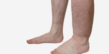Manche Menschen bekommen durch langes Stehen schnell geschwollene Füße. Andere leiden wiederum ständig unter den Flüssigkeitsansammlungen. (Bild: vchalup/stock.adobe.com)