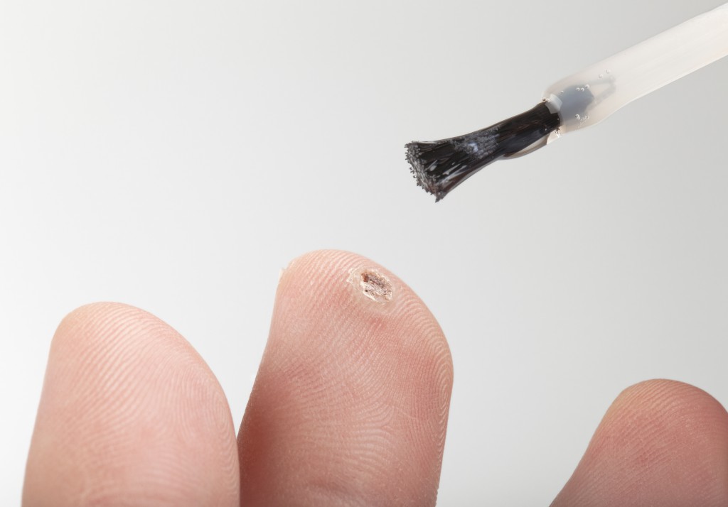 applying medicine to treat a wart