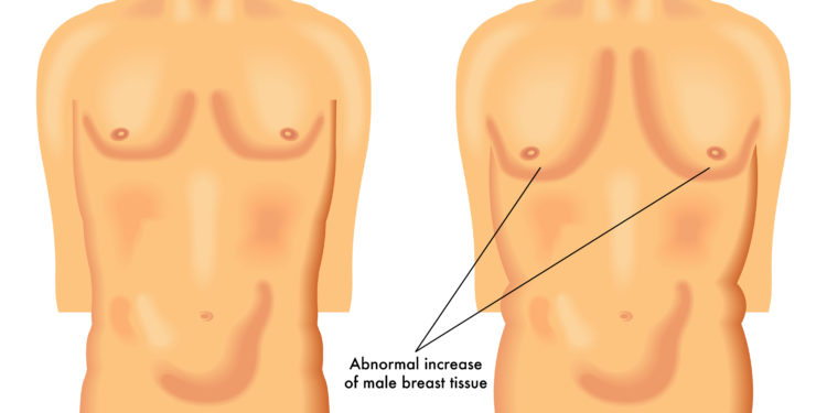 Schaubild über eine vergrößerte Männerbrust, die im Rahmen der Erkrankung Gynäkomastie auftreten kann.