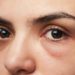 Ringe unter den Augen werden oft mit Schlafmangel und Erschöpfung in Verbindung gebracht. Doch die Verfärbungen der Haut können auch andere Ursachen wie z.B. eine Allergie oder Infektion haben. (Bild: PixieMe/fotolia.com)