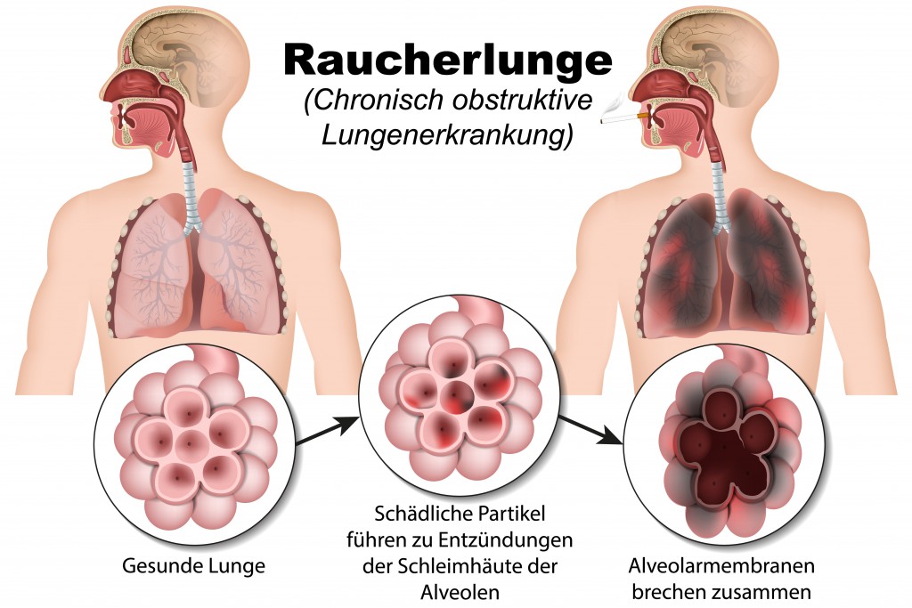 Chronisch obstruktive Lungenerkrankung, Raucherlunge