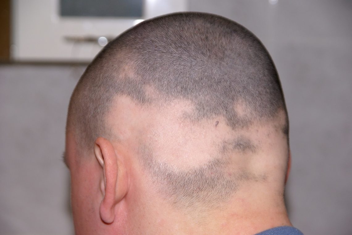 Kreisrunder Haarausfall Weiße Haare Wachsen www.heilpraxisnet.de