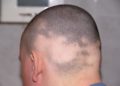 Kreisrunder Haarausfall kann an mehreren Stellen des Kopfes gleichzeitig auftreten. (Bild: Tomy/fotolia.com)