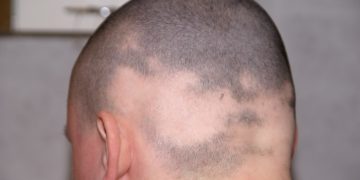 Kreisrunder Haarausfall kann an mehreren Stellen des Kopfes gleichzeitig auftreten. (Bild: Tomy/fotolia.com)