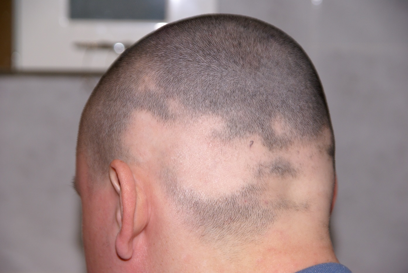 Выпадают волосы и брови. Очаговая алопеция (alopecia Areata). Гнёздная (очаговая алопеция). Преаурикулярная алопеция.