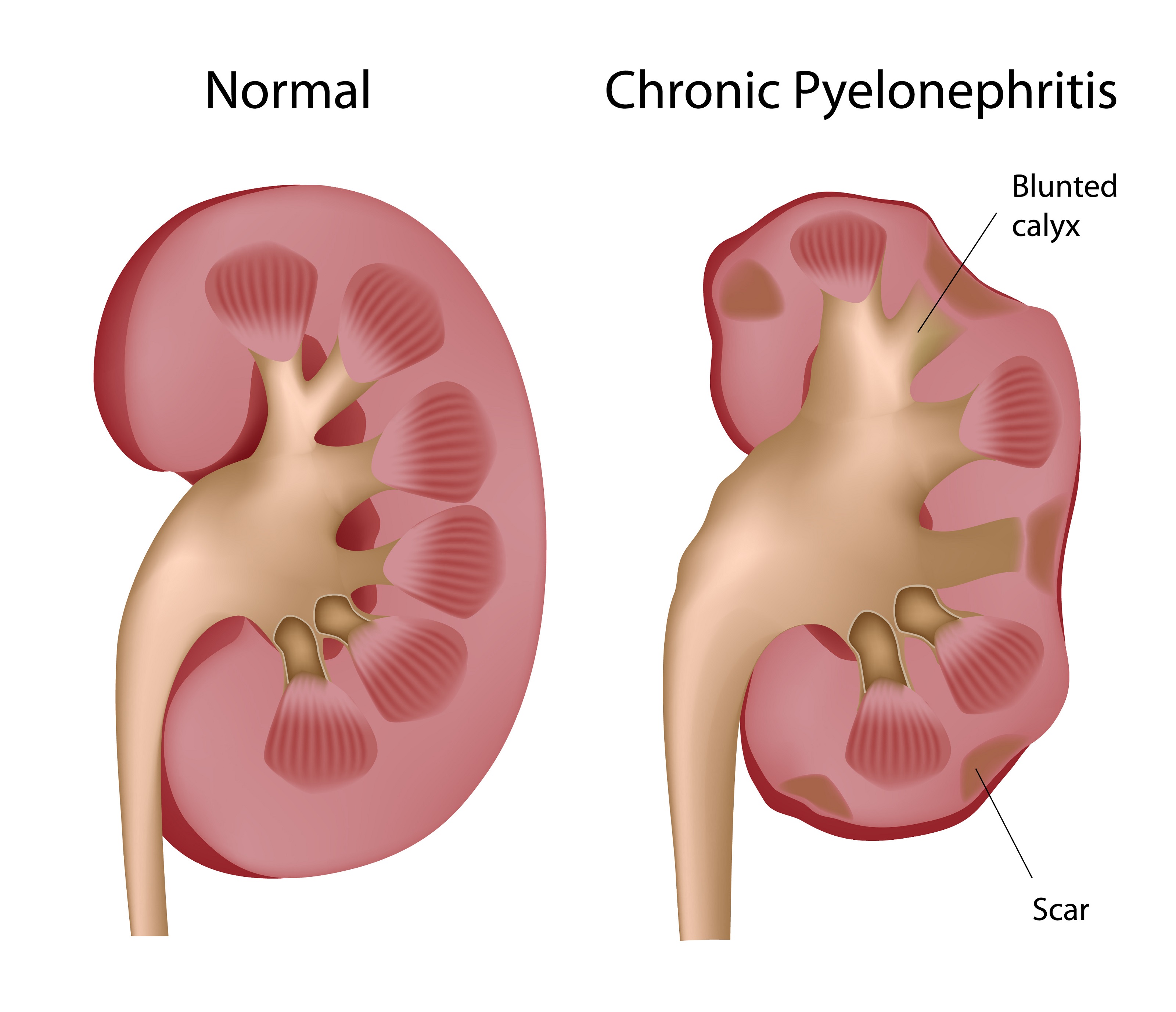 pyelonephritis kezelés krónikus cukorbetegségben