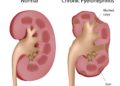 Nierenbeckenentzündungen können leicht in ein chronisches Beschwerdebild übergehen. (Bild: Alila Medical Media/fotolia.com)