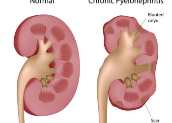 Nierenbeckenentzündungen können leicht in ein chronisches Beschwerdebild übergehen. (Bild: Alila Medical Media/fotolia.com)