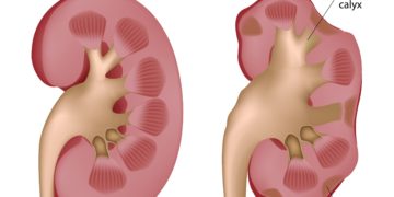 Nierenbeckenentzündungen können leicht in ein chronisches Beschwerdebild übergehen. (Bild: Alila Medical Media/fotolia.com)