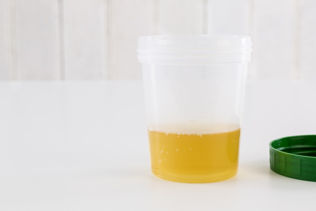 Urinbecher für eine Urinuntersuchung