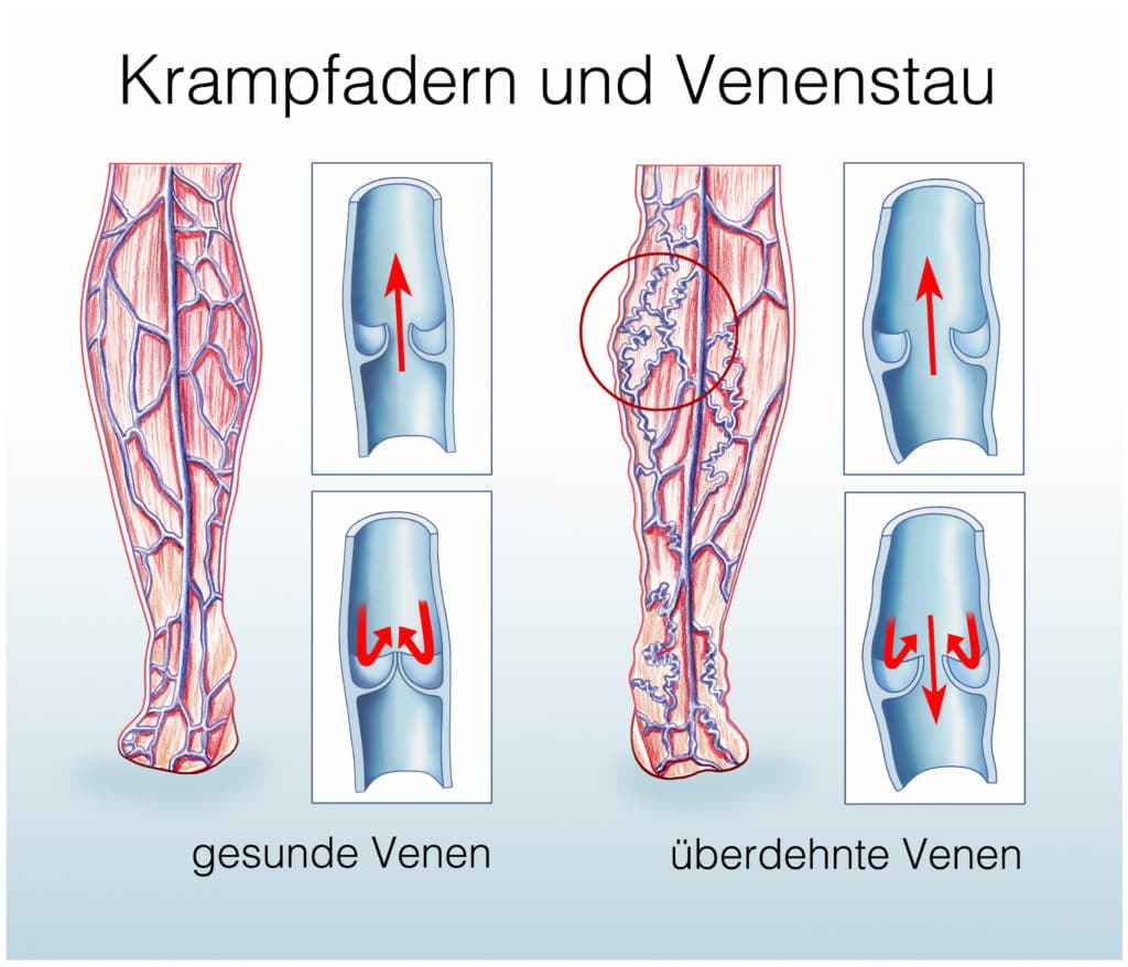 Ein Schaubild vergleicht gesunde Venen mit überdehnten Venen.