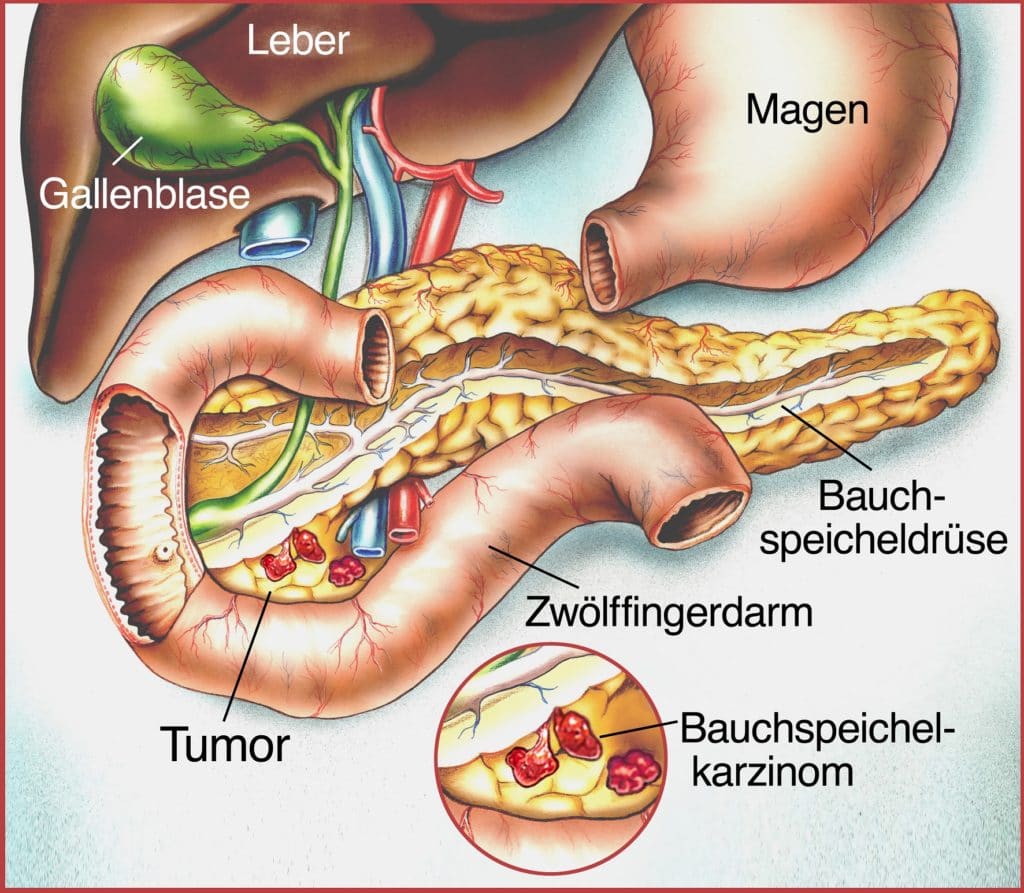 Schematische Zeichnung vom Verdauungstrakt und Bauchspeicheldrüse mit Karzinom.