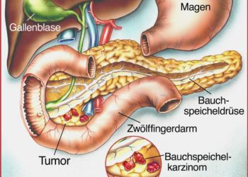 Schematische Zeichnung vom Verdauungstrakt und Bauchspeicheldrüse mit Karzinom.