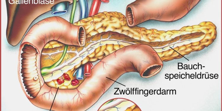 Schematische Zeichnung vom Verdauungstrakt und Bauchspeicheldrüse mit Karzinom.