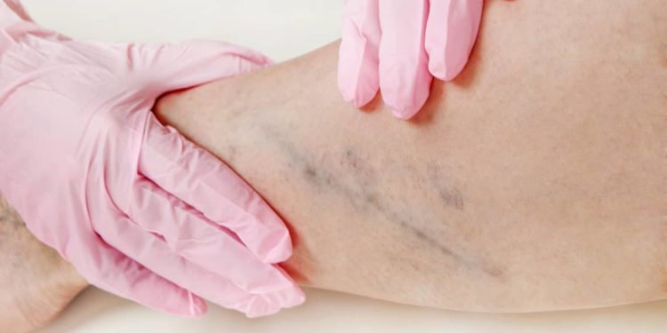 Welcher Arzt kann mir helfen bei geschwollenen Beinen?