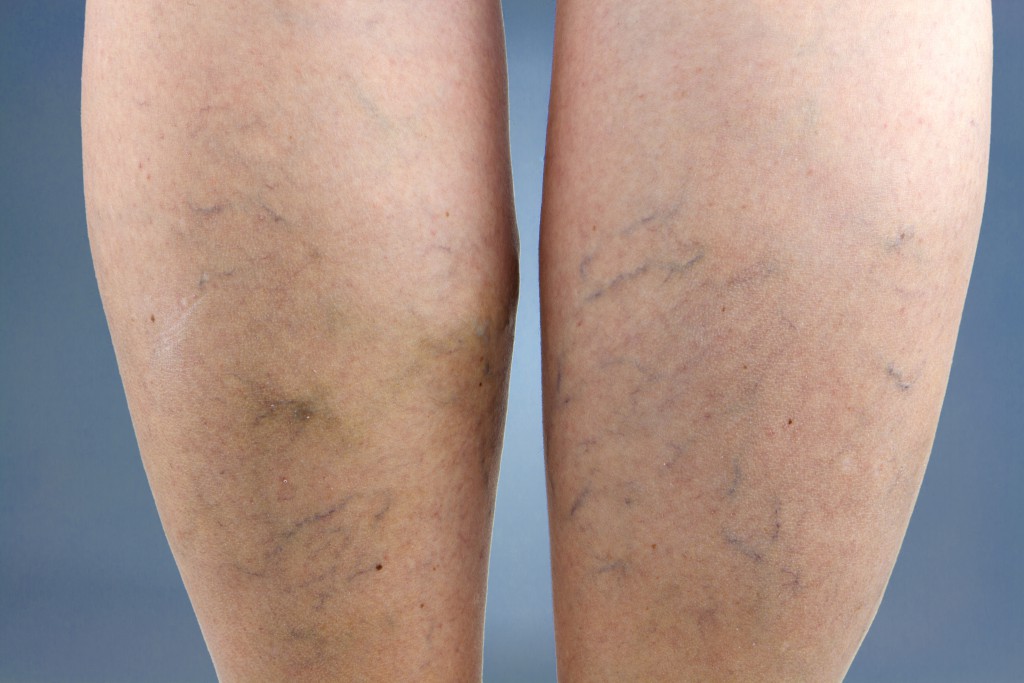 Varicose veins. Macro.