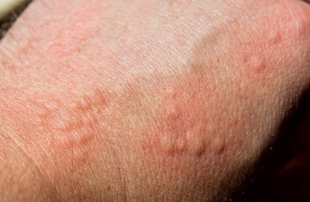 Juckender Hautausschlag kann sich zum Beispiel in Form von Quaddeln oder Bläschen zeigen. (Bild: Jürgen Fälchle/fotolia.com)