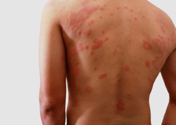 Oft beschränkt sich der Ausschlag auf bestimmte Körperbereiche wie den Rücken, Bauch oder die Achselhöhlen. (Bild: chaphot/fotolia.com)
