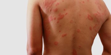 Oft beschränkt sich der Ausschlag auf bestimmte Körperbereiche wie den Rücken, Bauch oder die Achselhöhlen. (Bild:  chaphot/fotolia.com)