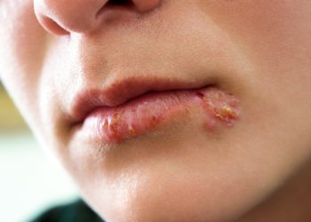 Herpes im Bereich von Mund und Lippen wird durch das Herpes-simplex-Virus Typ 1 hervorgerufen. (Bild: Cherries/fotolia.com)