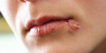 Herpes im Bereich von Mund und Lippen wird durch das Herpes-simplex-Virus Typ 1 hervorgerufen. (Bild: Cherries/fotolia.com)