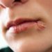 Herpes im Bereich von Mund und Lippen wird durch das Herpes-simplex-Virus Typ 1 hervorgerufen. (Bild: Cherries/fotolia.com)