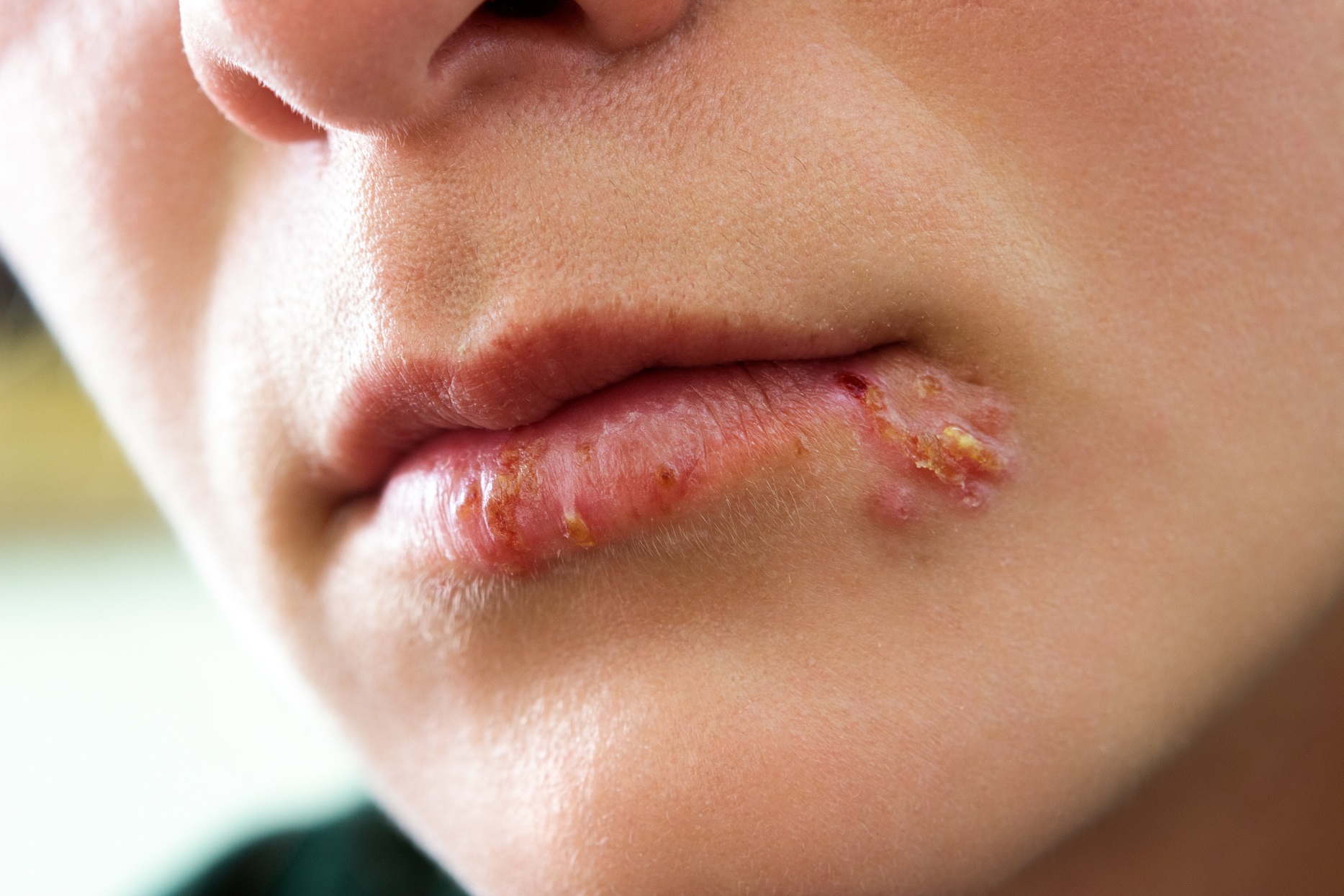 Herpes bleibt wie lange Sos lippenherpes