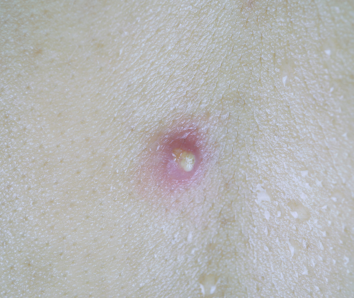 Abszess – Ursachen und Behandlung – Heilpraxis