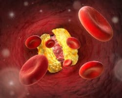 Eine Arterie ist mit Ablagerungen zugesetzt, die den Blutfluss behindern.