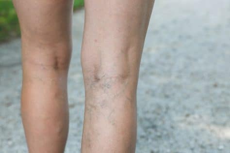 Jambes varices