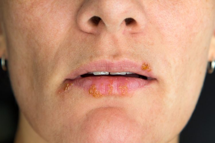 Neue Therapien Herpes mit körpereigenem Protein behandelbar Heilpraxis