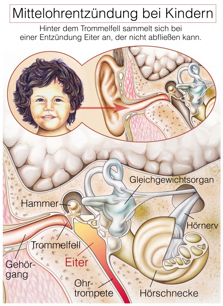 Mittelohrentzündung bei Kindern. (Bild: Henrie/fotolia)