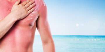 Der beste Schutz gegen Sonnenbrand ist, sich gar nicht erst zu lange ungeschützt der Sonne auszusetzen. (Bild: Rostislav Sedlacek/stock.adobe.com)
