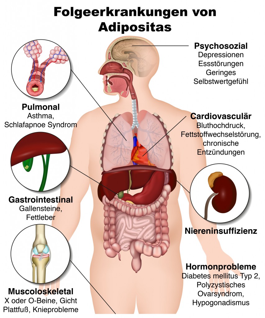 Das sind die möglichen gesundheitlichen Folgen von Adipositas.