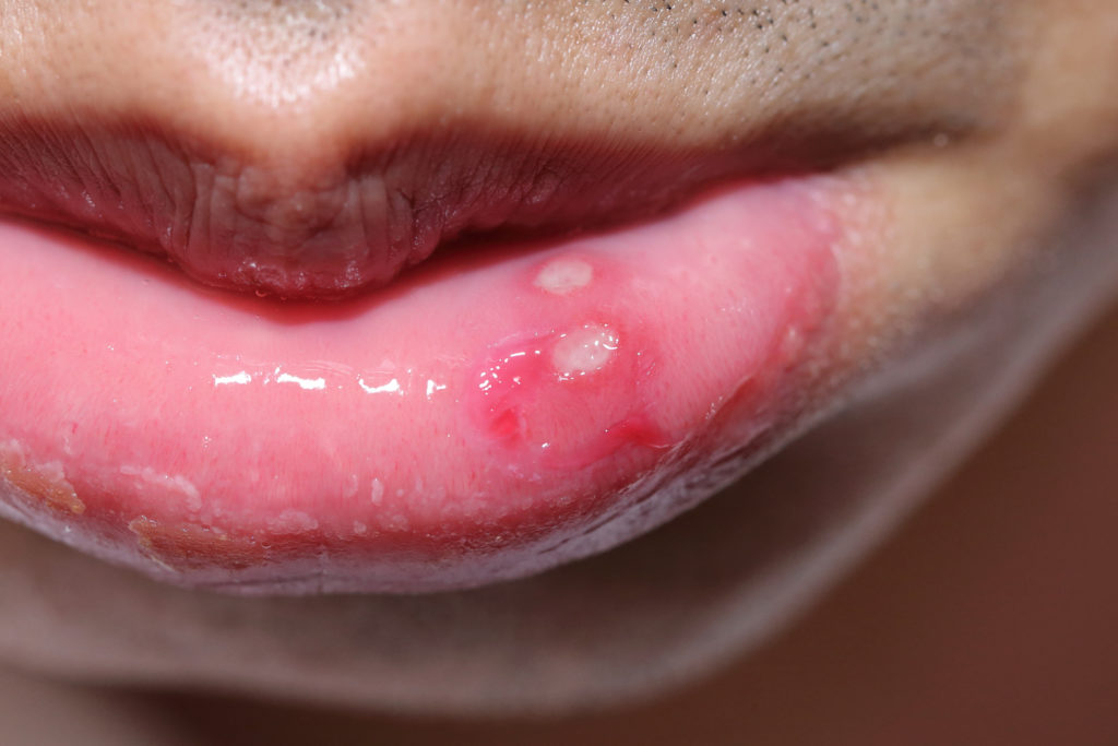 Aphthen sind Schädigungen der Mundschleimhaut, die insbesondere bei der Nahrungsaufnahme aber auch beim Sprechen und Schlucken des eigenen Speichels mit intensiven Schmerzen einhergehen können. (Bild: charnsitr/fotolia.com)