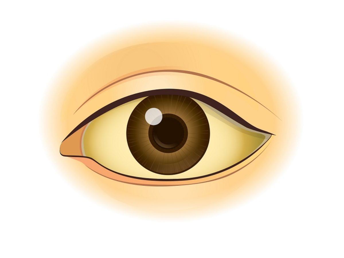 Alkoholiker Kinder Augen