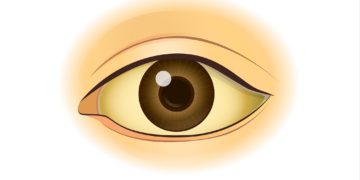 Eine Gelbfärbung des Auges deutet meist auf eine Erkrankung von Leber oder Galle hin. (Bild: logo3in1/fotolia.com)