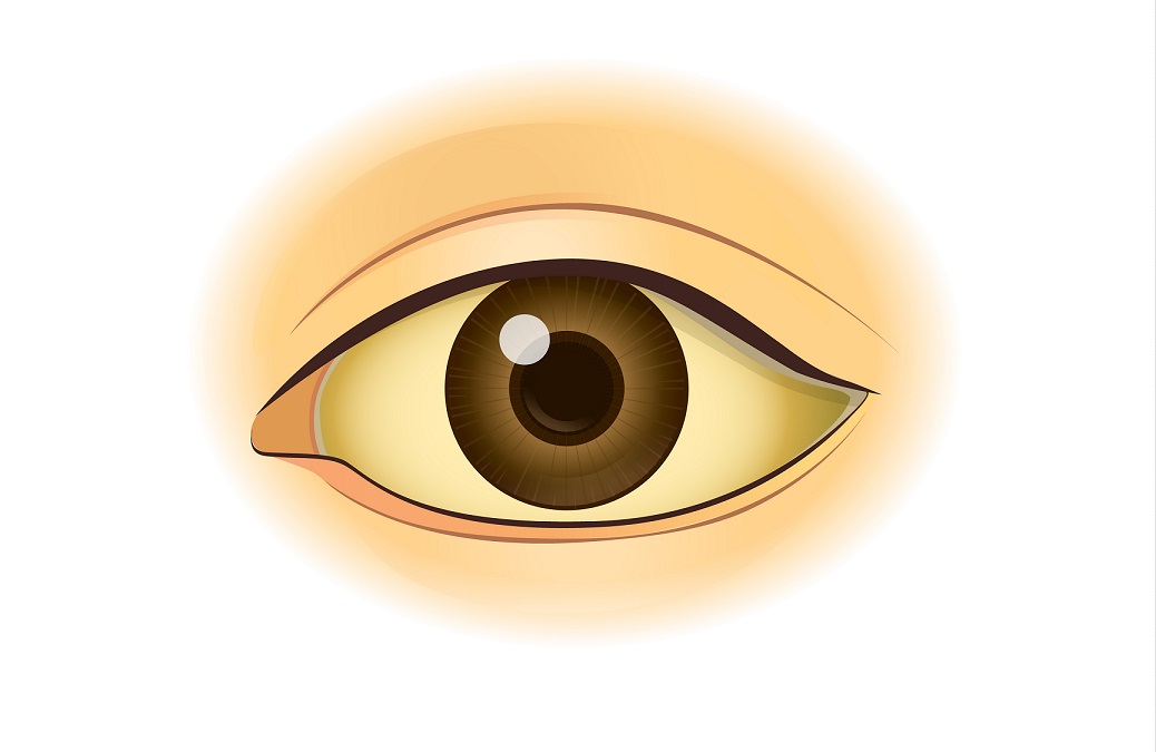 Gelbe Augen Ursachen Behandlung Und Vorbeugung Heilpraxis