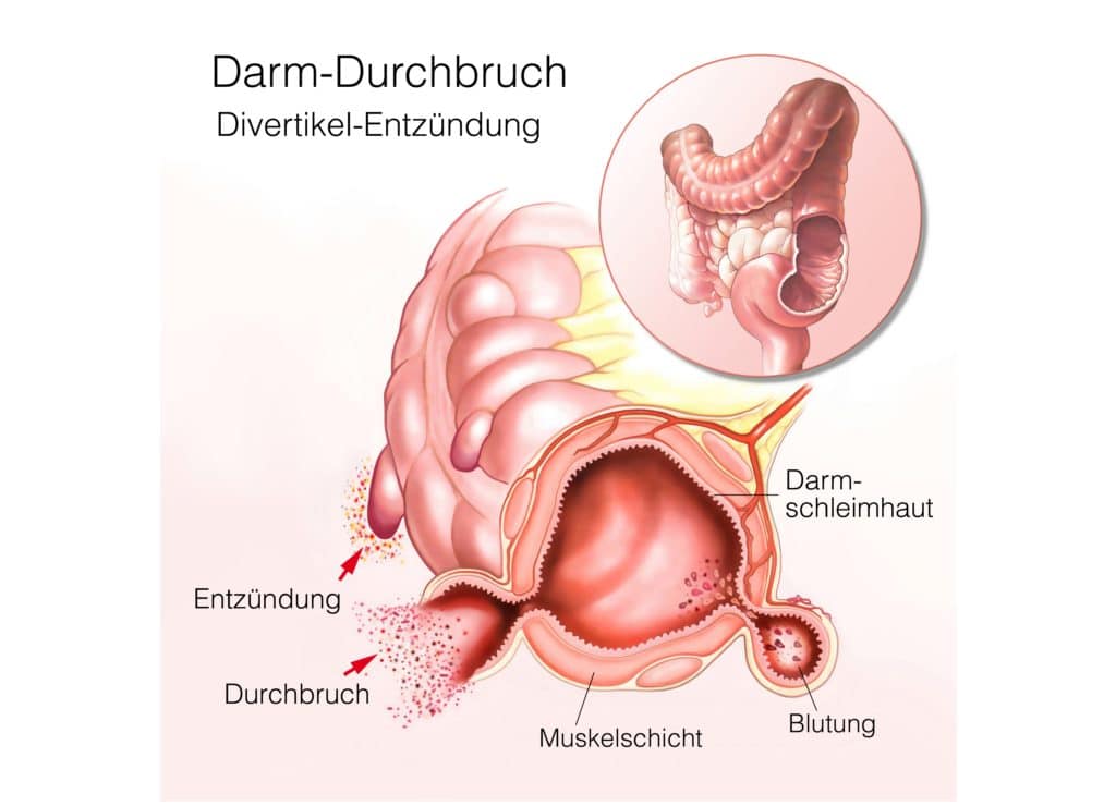 Ein Abschnitt des Dickdarms, bei dem eine entzündete Ausstülpung durchgebrochen ist.