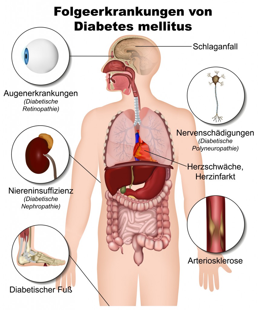 Folgeerkrankungen von Diabetes mellitus
