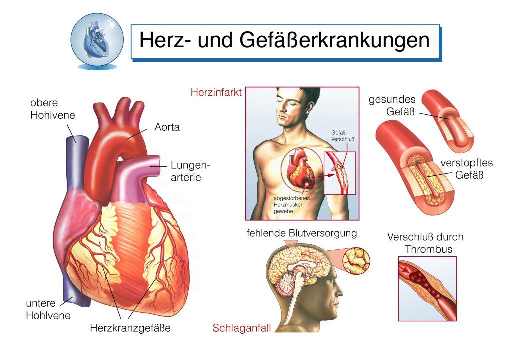 Herzkrankheiten