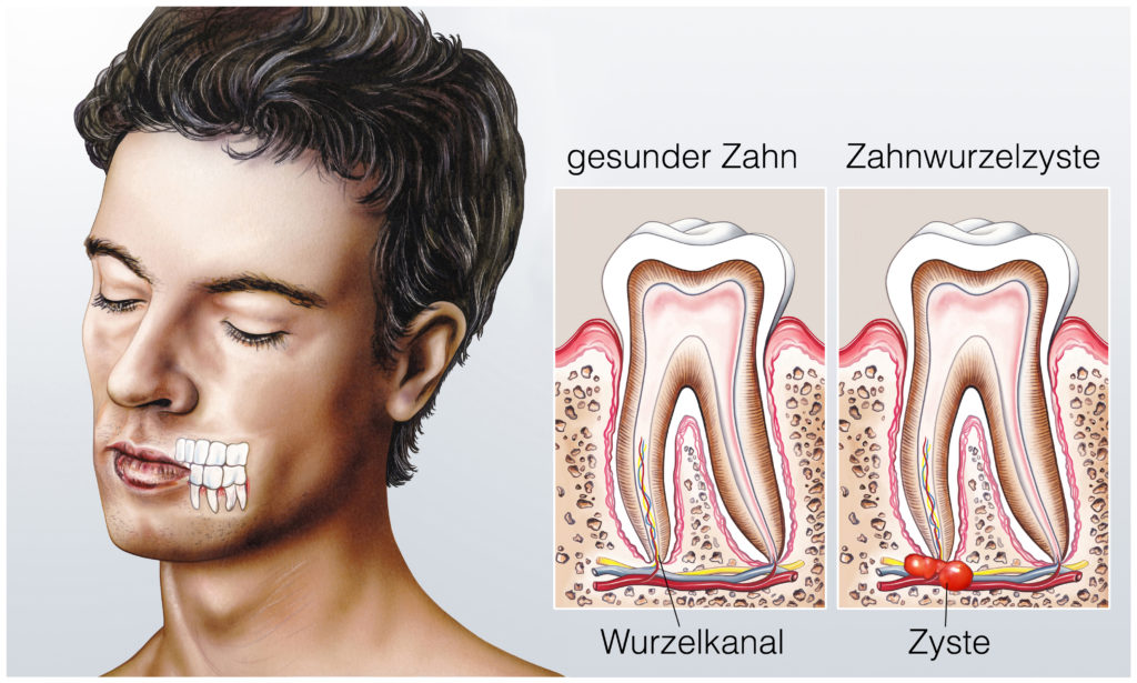 Gesunder Zahn.Zahnwurzelzyste